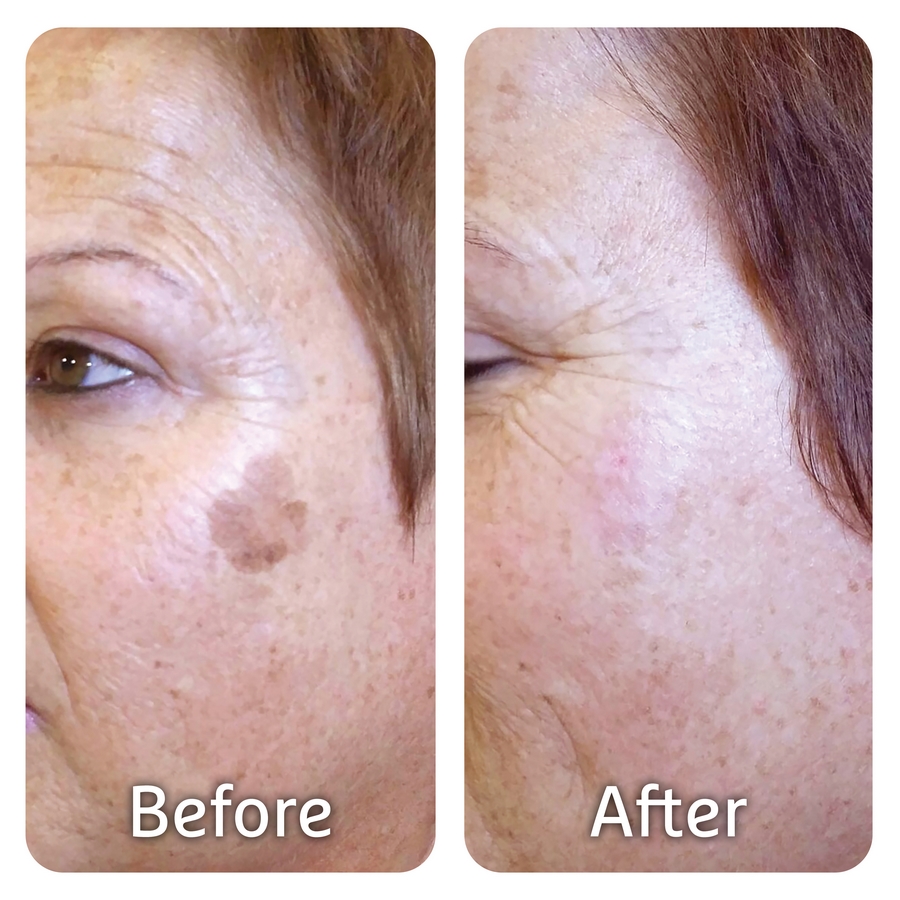 PICS Before After MED16