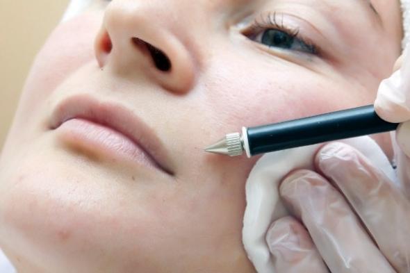 img etot vid epilyatsii mozhet byt ispolzovan dazhe dlya litsa min