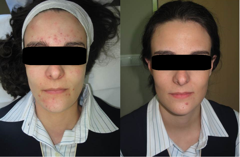acne 30days