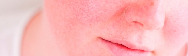 rosacea oxymetazoline