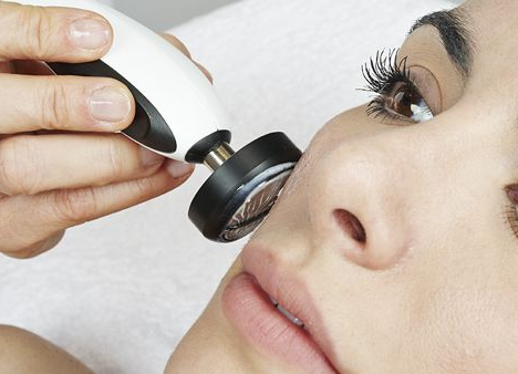 Radioviļņu liftings (bipolārs)