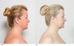 Лицевой фитнесс и Эстетические мануальные техники для лица и шеи